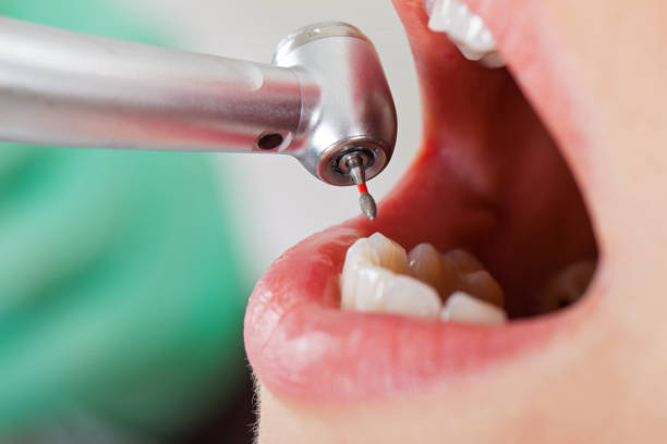 Best Emergency Treatment for Toothache in Butte, MT